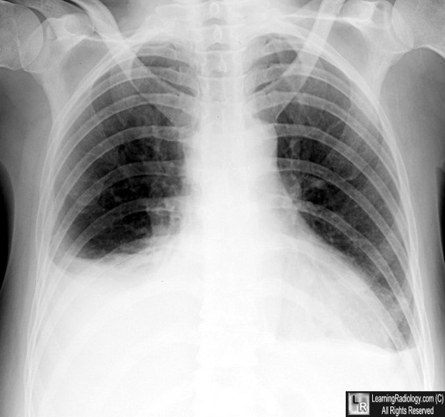 Bilateral Pleural Effusions